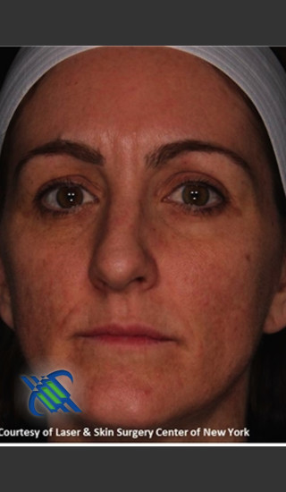 After Photo for Full Face Skin Rejuvenation - Roy G. Geronemus, M.D. - Prejuvenation