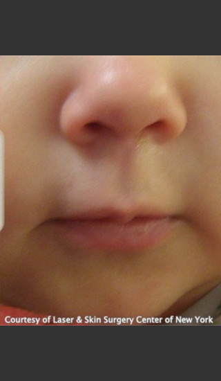 After Photo for Treatment of Mouth Port Wine Stain  - Roy G. Geronemus, M.D. - Prejuvenation