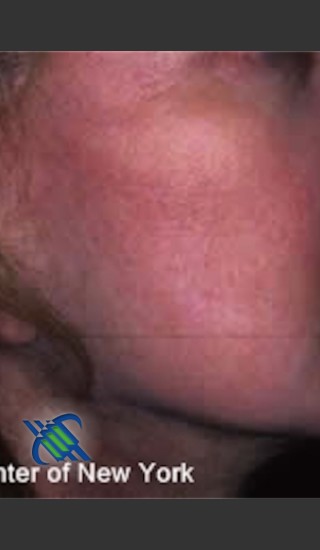 After Photo for Treatment of Right Cheek Pigmentation - Roy G. Geronemus, M.D. - Prejuvenation