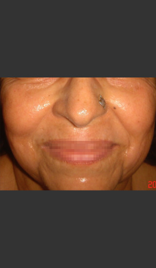 After Photo for Infini Rhytides Treatment #20 -  - Prejuvenation