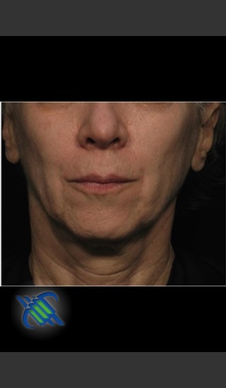 After Photo for Treatment of Facial Laxity with Profound - Roy G. Geronemus, M.D. - Prejuvenation