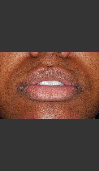 Before Photo for Treatment of Lips - Roy G. Geronemus, M.D. - Prejuvenation