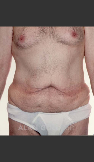 Before Photo for Abdominoplasty 320 - Alan Gold MD - Prejuvenation