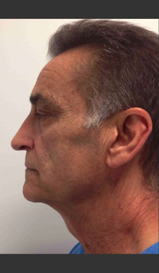 After Photo for Infini Rhytides Treatment #21 -  - Prejuvenation