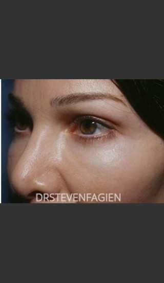 After Photo for Periorbital Rejuvenation - Patient 7 - Steven Fagien, MD - Prejuvenation