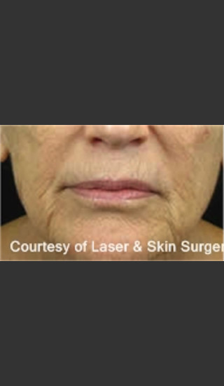 Before Photo for Treatment of Fine lines and Wrinkles -  - Prejuvenation