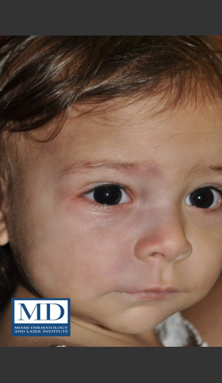 After Photo for Port Wine Stain Treatment 103 - Jill S. Waibel, MD - Prejuvenation