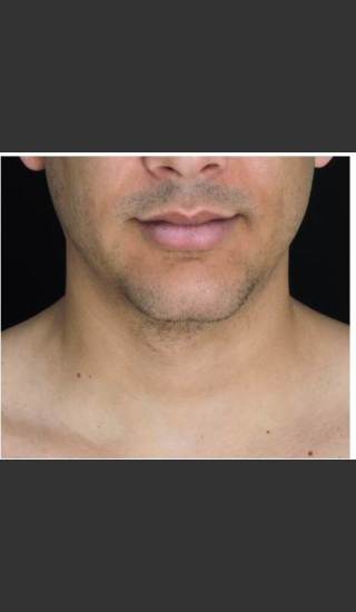 After Photo for Double Chin Removed 1 CoolSculpting Treatment  - Leyda Elizabeth Bowes, M.D. - Prejuvenation