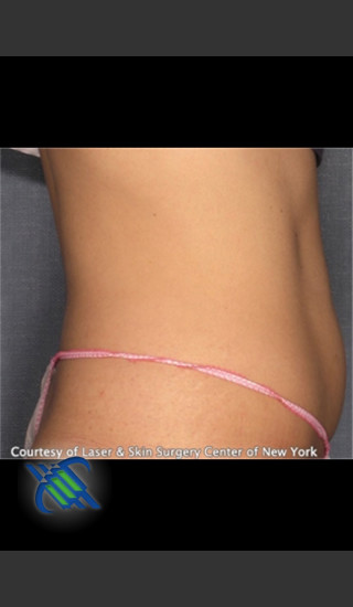 After Photo for Treatment of Lower Abdomen Right Side - Roy G. Geronemus, M.D. - Prejuvenation