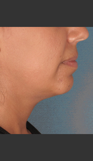Before Photo for Kybella Treatment 34 Year Old Female -  - Prejuvenation