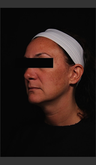 Before Photo for Treatment of Melasma -  - Prejuvenation