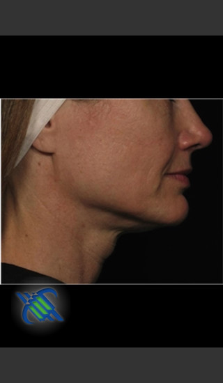 Before Photo for Profound Treatment of Lower Facial Laxity - Roy G. Geronemus, M.D. - Prejuvenation