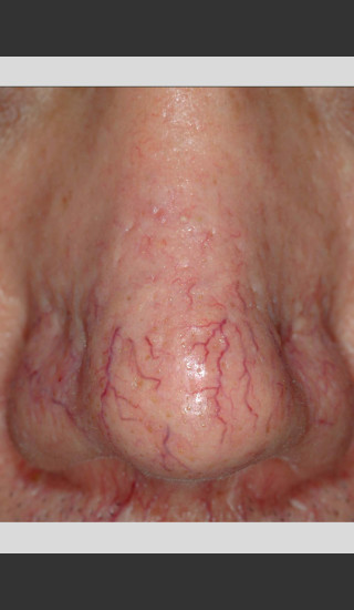 Before Photo for Gentle Laser Vascular Lesions of the Nose -  - Prejuvenation