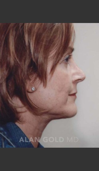 After Photo for Rhytidectomy (Facelift) 120 Side View - Alan Gold MD - Prejuvenation