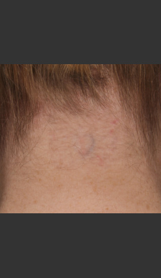 After Photo for Treatment of Neck Tattoo - Roy G. Geronemus, M.D. - Prejuvenation