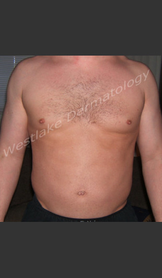 Before Photo for SmartLipo Liposuction of Male Abdomen - Gregory A Nikolaidis - Prejuvenation