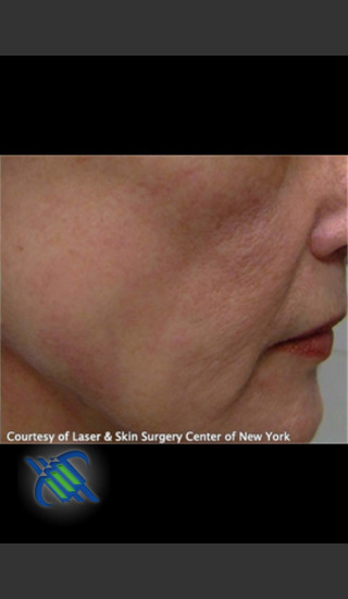 After Photo for Facial Blood Vessels on Side of Face - Roy G. Geronemus, M.D. - Prejuvenation