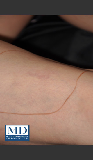 After Photo for Sclerotherapy Treatment 138 - Jill S. Waibel, MD - Prejuvenation