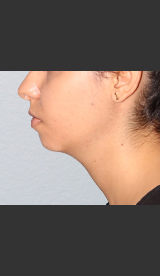 Before Photo for Chin Augmentation - Bryan J. Correa, MD - Prejuvenation