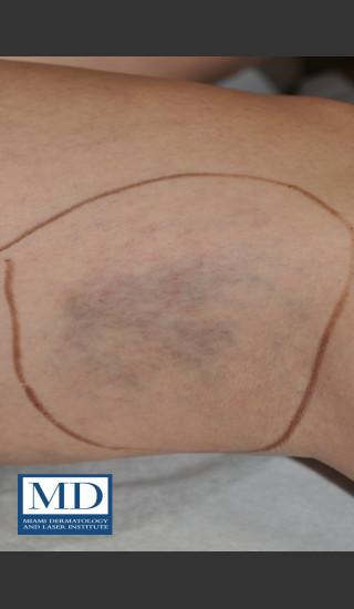 Before Photo for Sclerotherapy Treatment 138 - Jill S. Waibel, MD - Prejuvenation