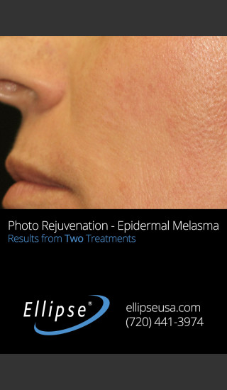 After Photo for Treatment of Pigmentation and Melasma  -  - Prejuvenation
