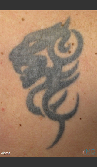 Before Photo for Picosure Laser Tattoo Removal - Robert Weiss, M.D., F.A.A.D., F.A.C.Ph - Prejuvenation