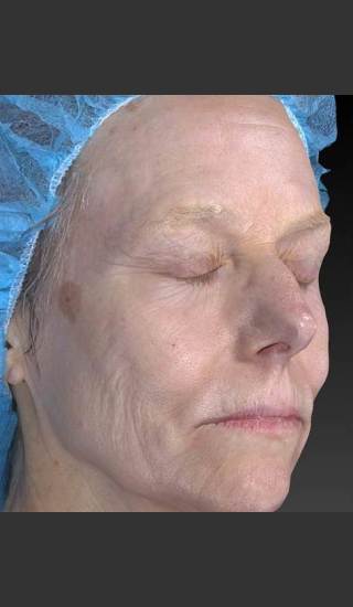 Before Photo for Wrinkle and Brown Spot Reduction - Douglas Wu, M.D. - Prejuvenation