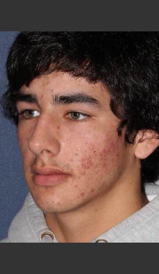 Before Photo for Treatment of Acne  - Mitchel P. Goldman M.D. - Prejuvenation