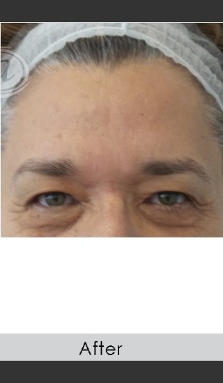 After Photo for Dysport and Filler for Forehead Etched Lines - Annie Chiu, MD - Prejuvenation