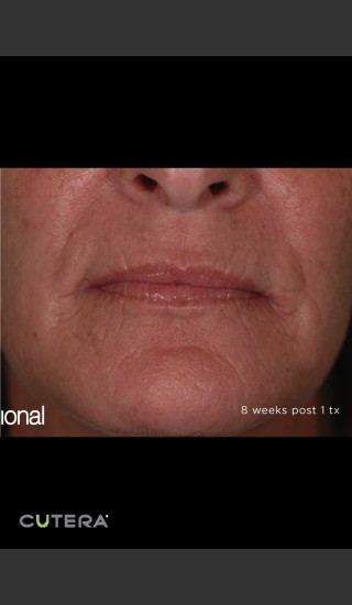 After Photo for Pearl Fusion Resurfacing of Wrinkles -  - Prejuvenation