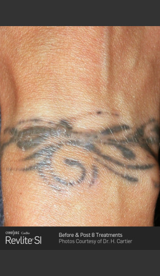 Before Photo for Revlite SI laser Tattoo Removal -  - Prejuvenation