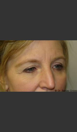 Before Photo for Blepharoplasty 6307 - Sanjay Grover MD FACS - Prejuvenation