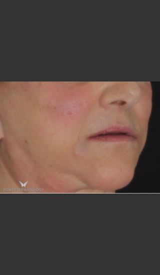 After Photo for Radiesse and Juvederm Ultra - Leyda Elizabeth Bowes, M.D. - Prejuvenation