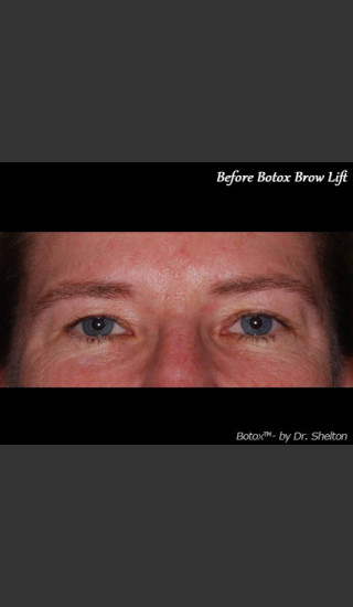 Before Photo for Treatment of Perioral Wrinkles - Ron M. Shelton, M.D. - Prejuvenation