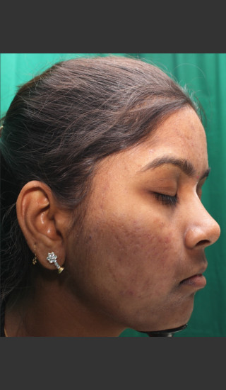 After Photo for Infini Rhytides Treatment #22 -  - Prejuvenation