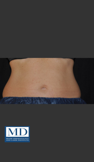 After Photo for  Body Contouring Treatment 143 - Jill S. Waibel, MD - Prejuvenation