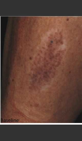 Before Photo for Treatment of Tattoo -  - Prejuvenation