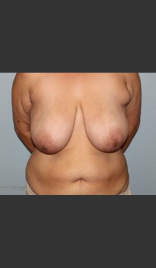 Before Photo for Breast Lift Case #1 - Bryan J. Correa, MD - Prejuvenation