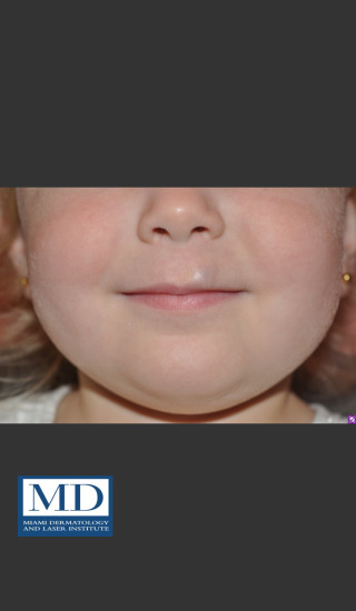 After Photo for Hemangioma Treatment 107 - Jill S. Waibel, MD - Prejuvenation