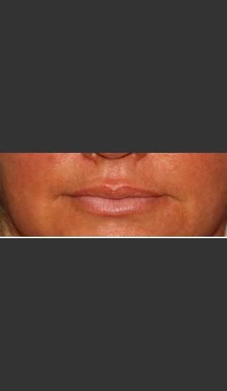After Photo for Lip Plumping Treatment - William F. Groff, M.D. - Prejuvenation