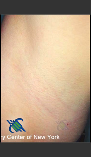 After Photo for Hair Removal of Female Under Arms - Roy G. Geronemus, M.D. - Prejuvenation