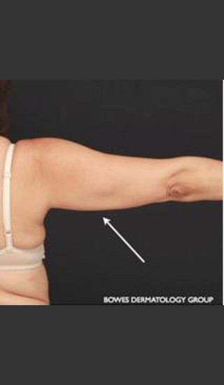 After Photo for CoolSculpting on Woman's Upper Arm - Leyda Elizabeth Bowes, M.D. - Prejuvenation