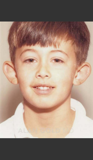 Before Photo for Otoplasty Case 114 - Alan Gold MD - Prejuvenation