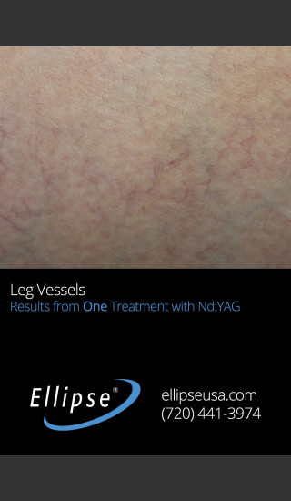 After Photo for 21 Weeks Single Leg Vein Treatment -  - Prejuvenation