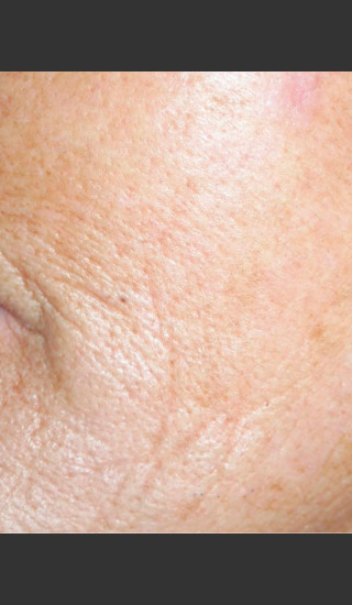 After Photo for Quanta Eterna IPL Treatment #77 -  - Prejuvenation