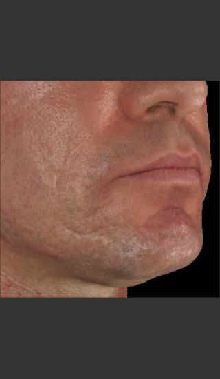 After Photo for Infini Acne Scar Treatment #13 -  - Prejuvenation