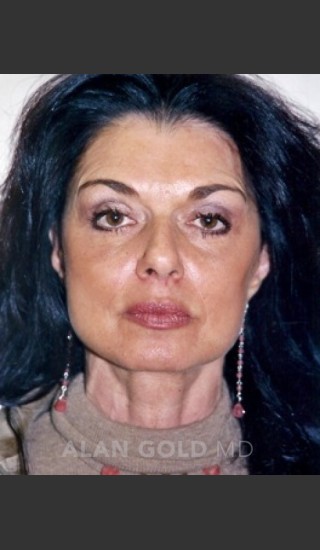 After Photo for Rhytidectomy (Facelift) 1884 - Alan Gold MD - Prejuvenation