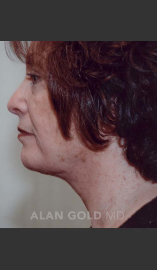 After Photo for Liposuction of Neck 89 Side View - Alan Gold MD - Prejuvenation