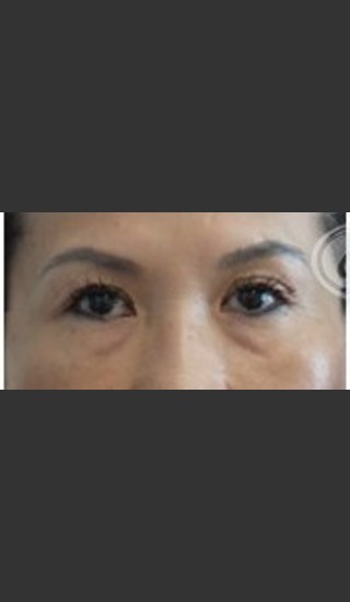 Before Photo for Undereye Filler - Annie Chiu, MD - Prejuvenation