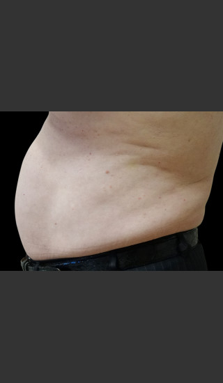 After Photo for Body Contouring Treatment #116 -  - Prejuvenation